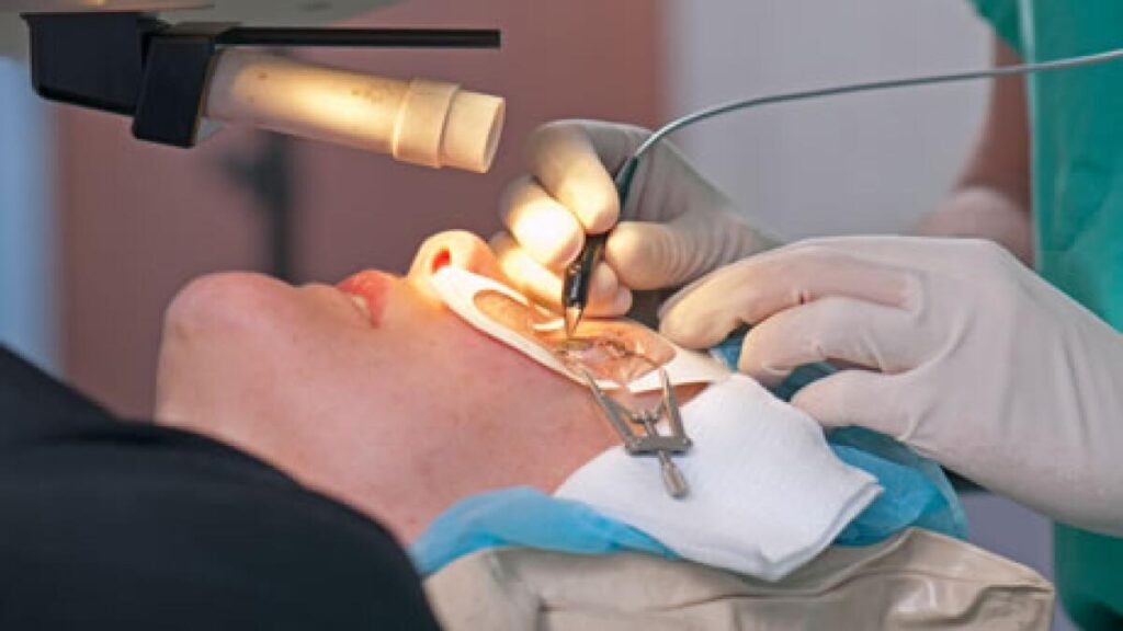 How To Hasten Your Recovery After Laser Eye Surgery Sydney