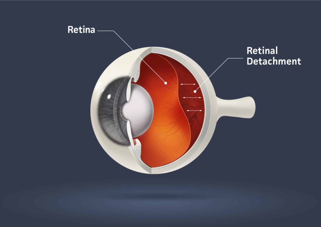 retinal treatments